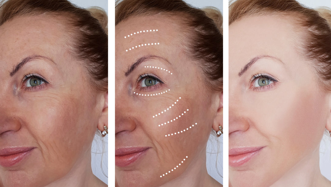 Résultats visibles des soins anti-âge Derma'Love : comparaison en trois étapes montrant l'avant, le diagnostic des zones à traiter et l'après traitement. La transformation révèle l'efficacité de nos formules naturelles sur les rides d'expression et la fermeté du visage, pour une peau visiblement plus lisse et éclatante.