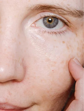 Gros plan sur un visage avec un doigt pointant des taches de rousseur légères sur une peau claire. L'œil gris-bleu et la peau naturelle illustrent les préoccupations courantes liées à l'hyperpigmentation que les soins ciblés Derma'Love aident à uniformiser tout en respectant la beauté naturelle de la peau.